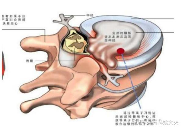 腰椎間盤膨出,怎樣的睡姿對腰好?