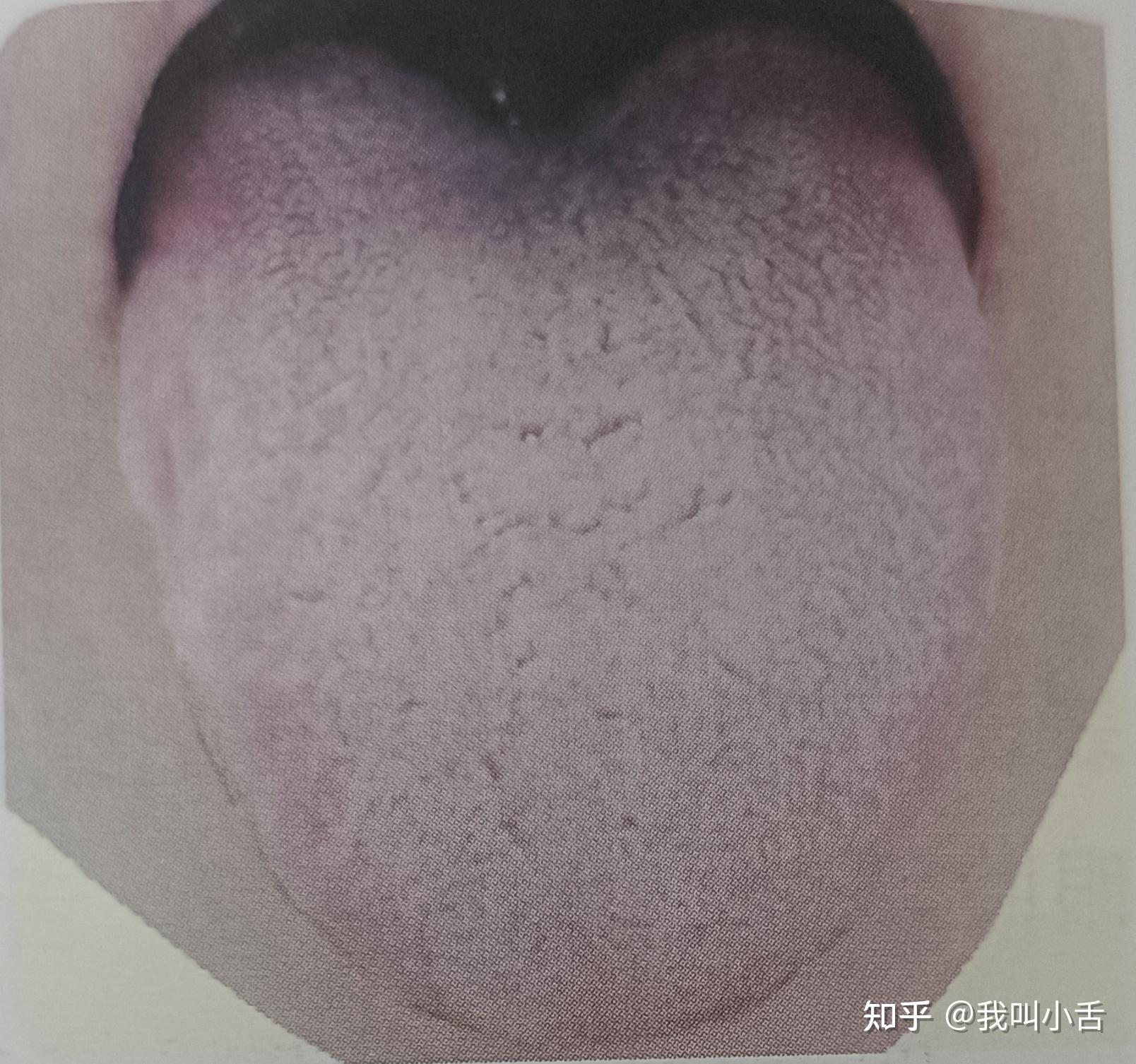 舌苔是如何形成的?白苔长什么样?如何判断自己的舌象呢?智能舌象助手来帮你! - 知乎