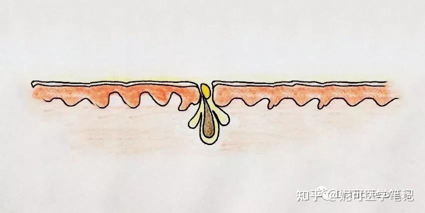 学习分享105黑头粉刺是怎么形成的