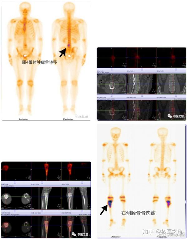SPECT/CT临床应用 - 知乎