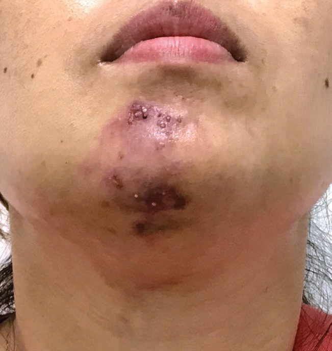 玻尿酸注射隆下巴血管意外的处理方案病例报告