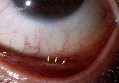 确诊为结膜吸吮线虫……是一种寄生在狗,猫等动物眼部的线虫……黄