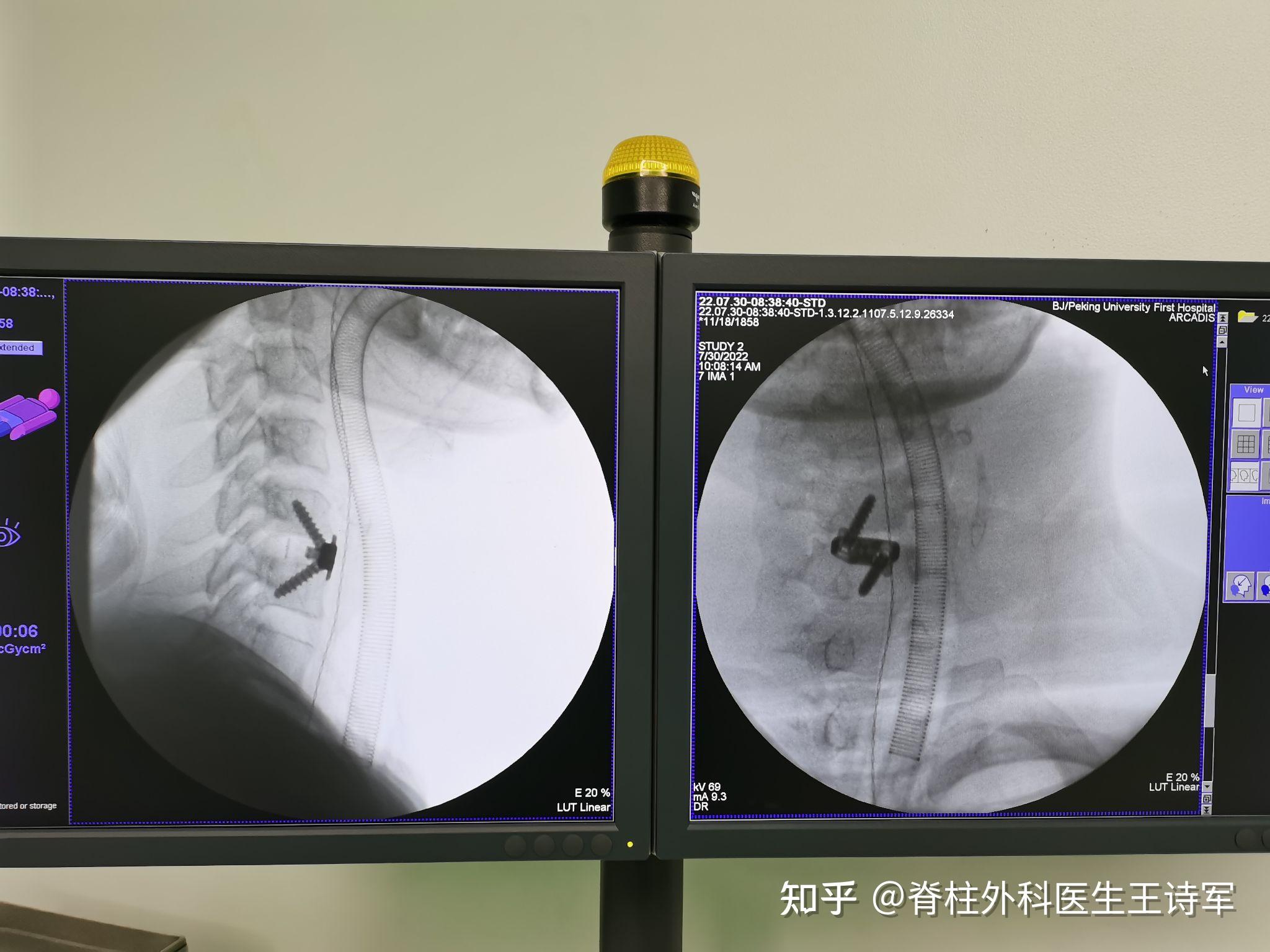 acdf手术治疗脊髓型颈椎病