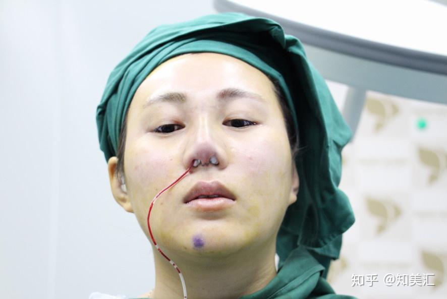 硅胶隆鼻的整形历程