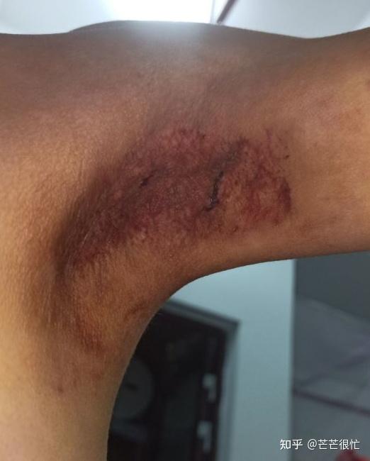 腋下微创手术记录