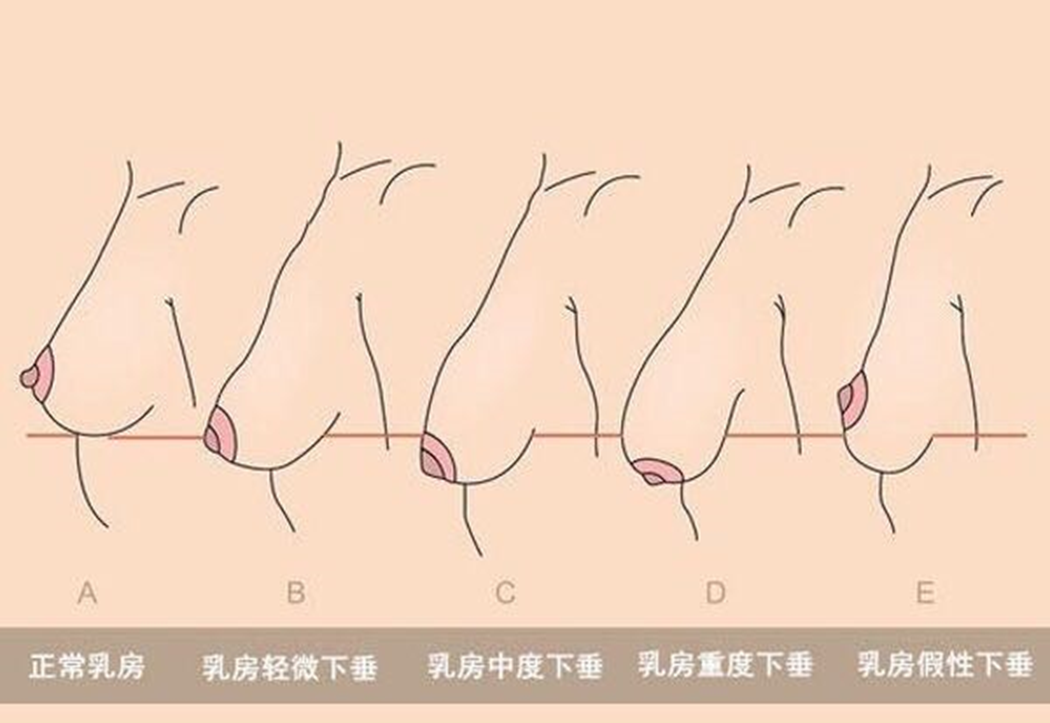 隆胸方式乳房矫正全介绍下胸型发育不正乳房下垂乳头内陷