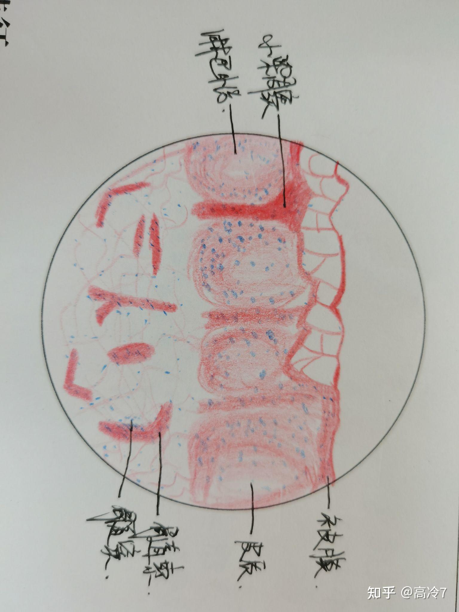 淋巴结结核病理手绘图图片