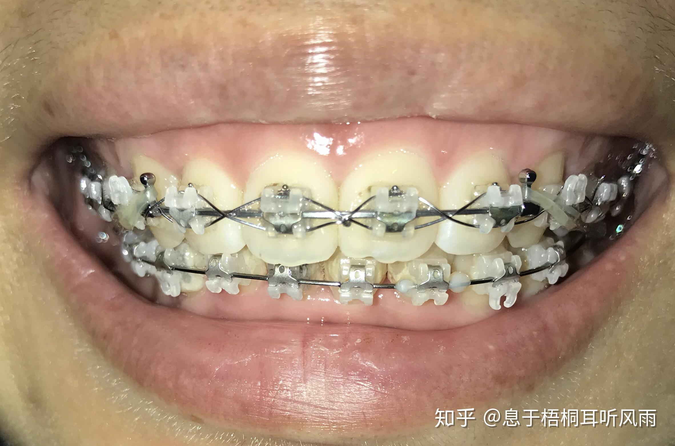 什么是牙套图片 v2-b89458ba1944368ce3f59230396fa553_r.jpg