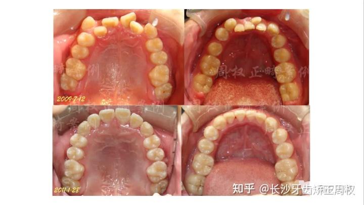 長沙牙齒矯正丨嚴重擁擠非拔牙牙齒矯正案例 - 知乎