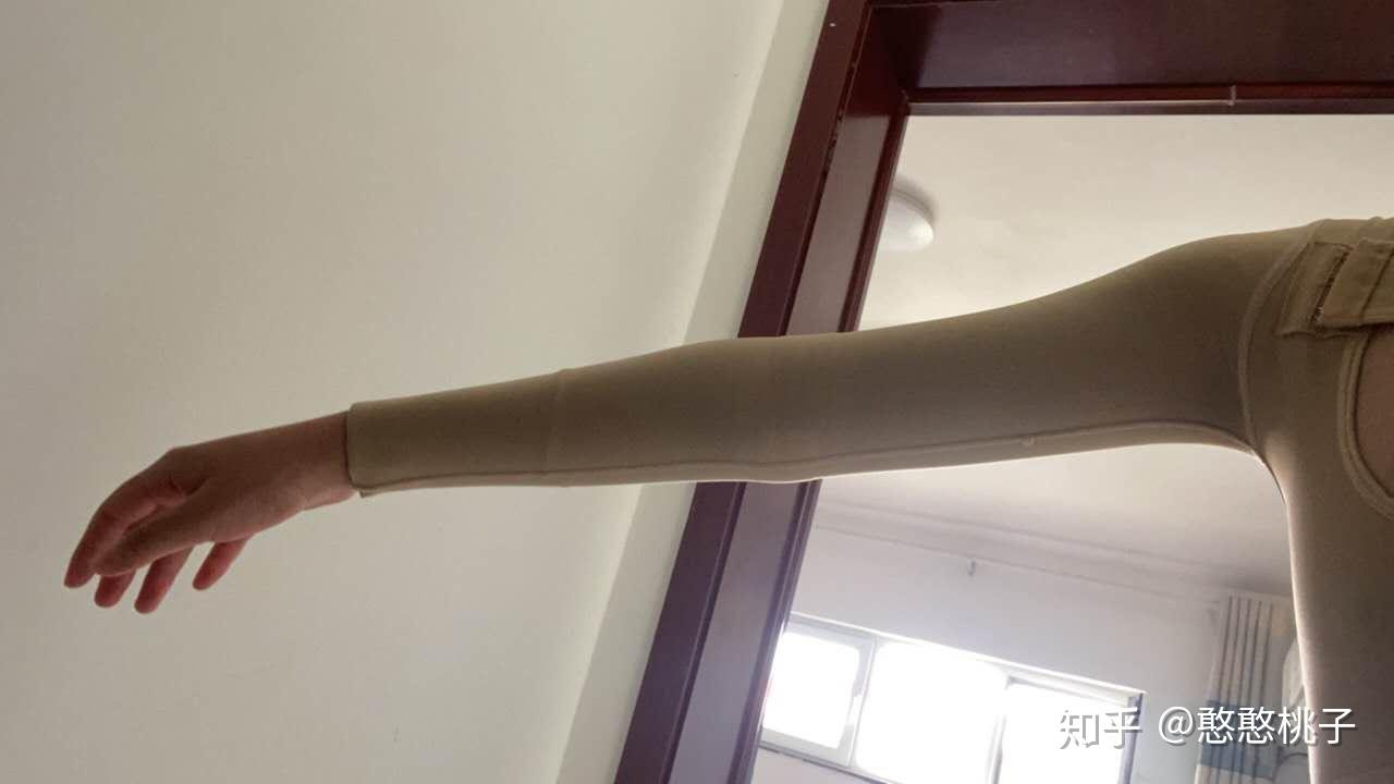 北京手臂吸脂术后恢复记录分享记录真实状态北京吸脂医院医生哪里好