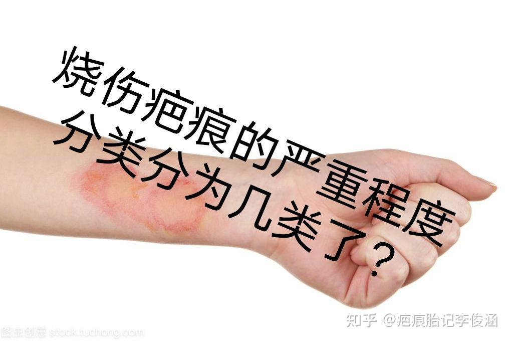 烧伤疤痕的严重程度分类分为几类了? - 知乎