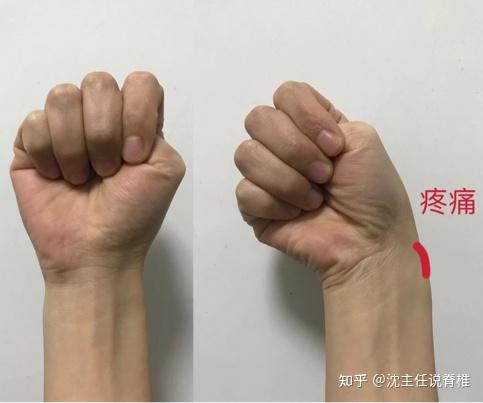 手腕疼痛使不上力为何女性更容易得腱鞘炎