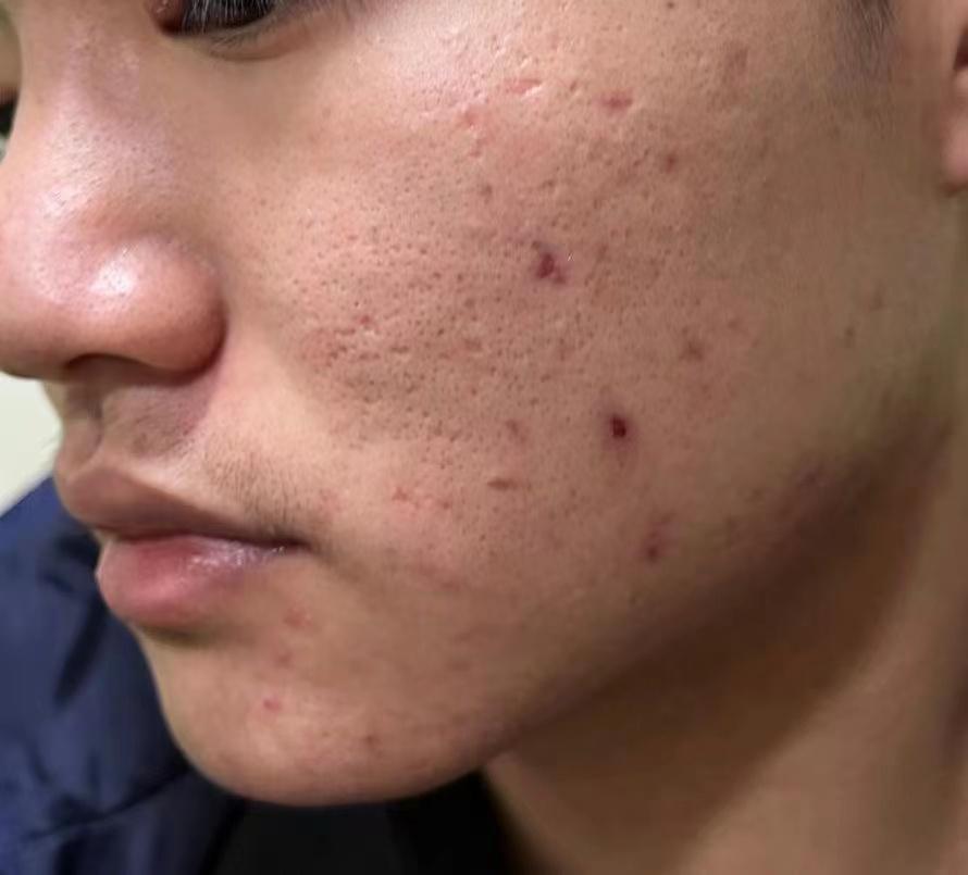 脸上痘印用什么消