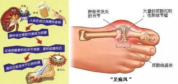 痛风患者应该怎么吃目前,原发性痛风并不能实现根治,除了紧急的止痛