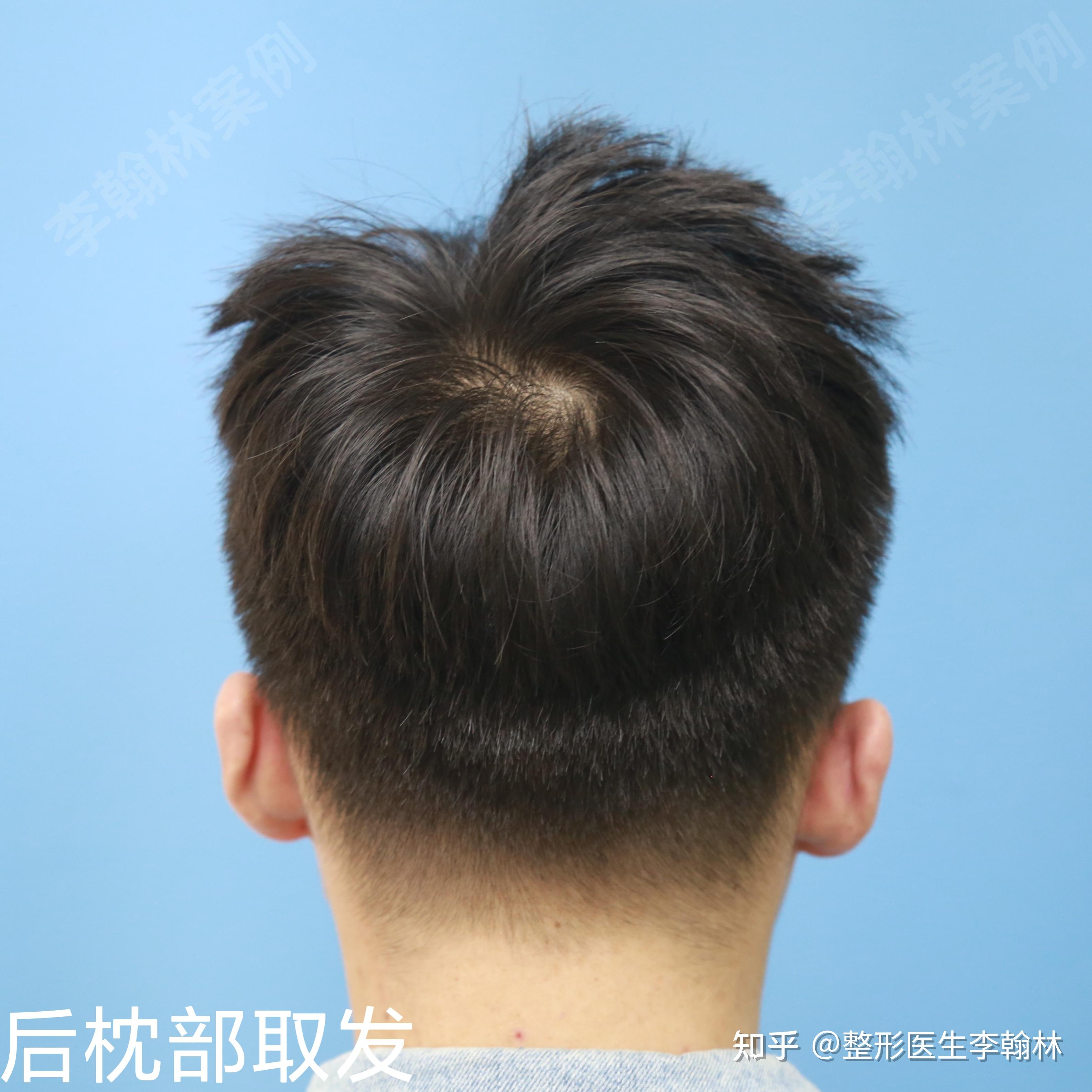 植发后发碴不长(植发长出来的头发弯曲毛糙)