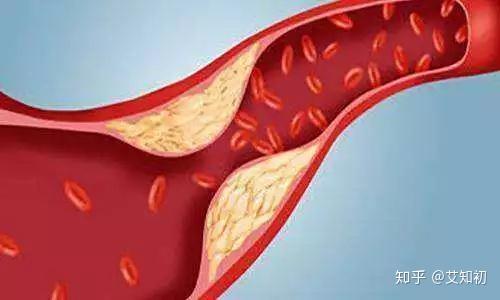 5个习惯让血管恢复 弹性 防止硬化 知乎