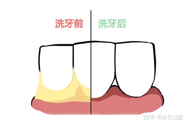 牙结石和牙垢的区别图片