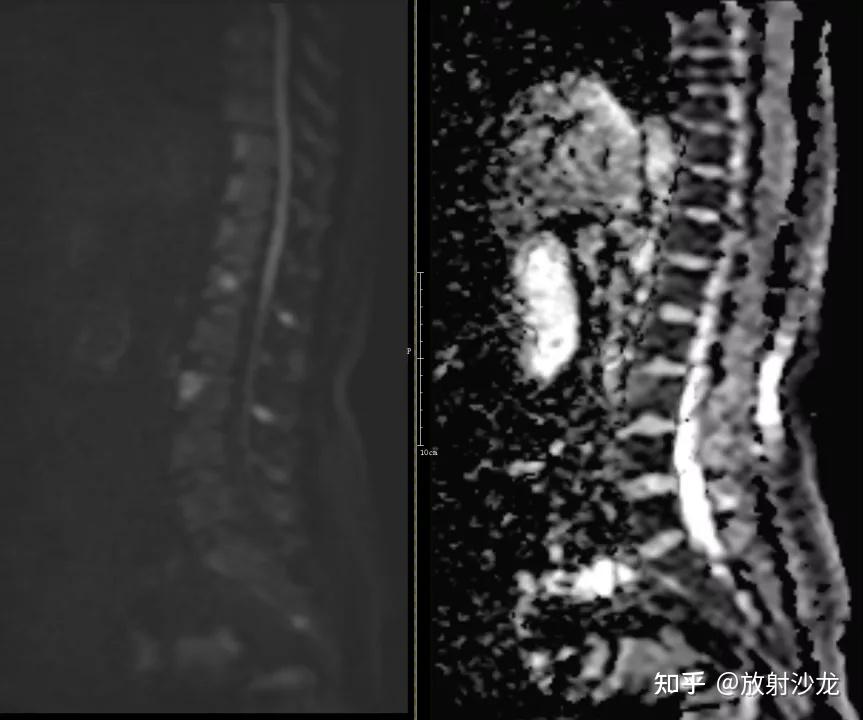 椎体终板炎 | 发生机制、分型以及 MRI 表现 - 知乎