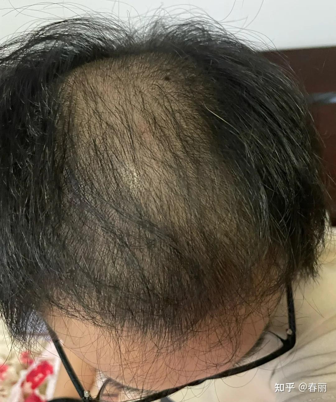 秃头对男生的杀伤力有多大？ - 知乎