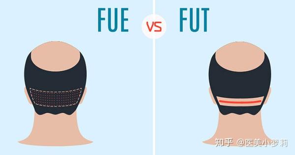 非切开比较微创 那有没有什么缺点呢 知乎