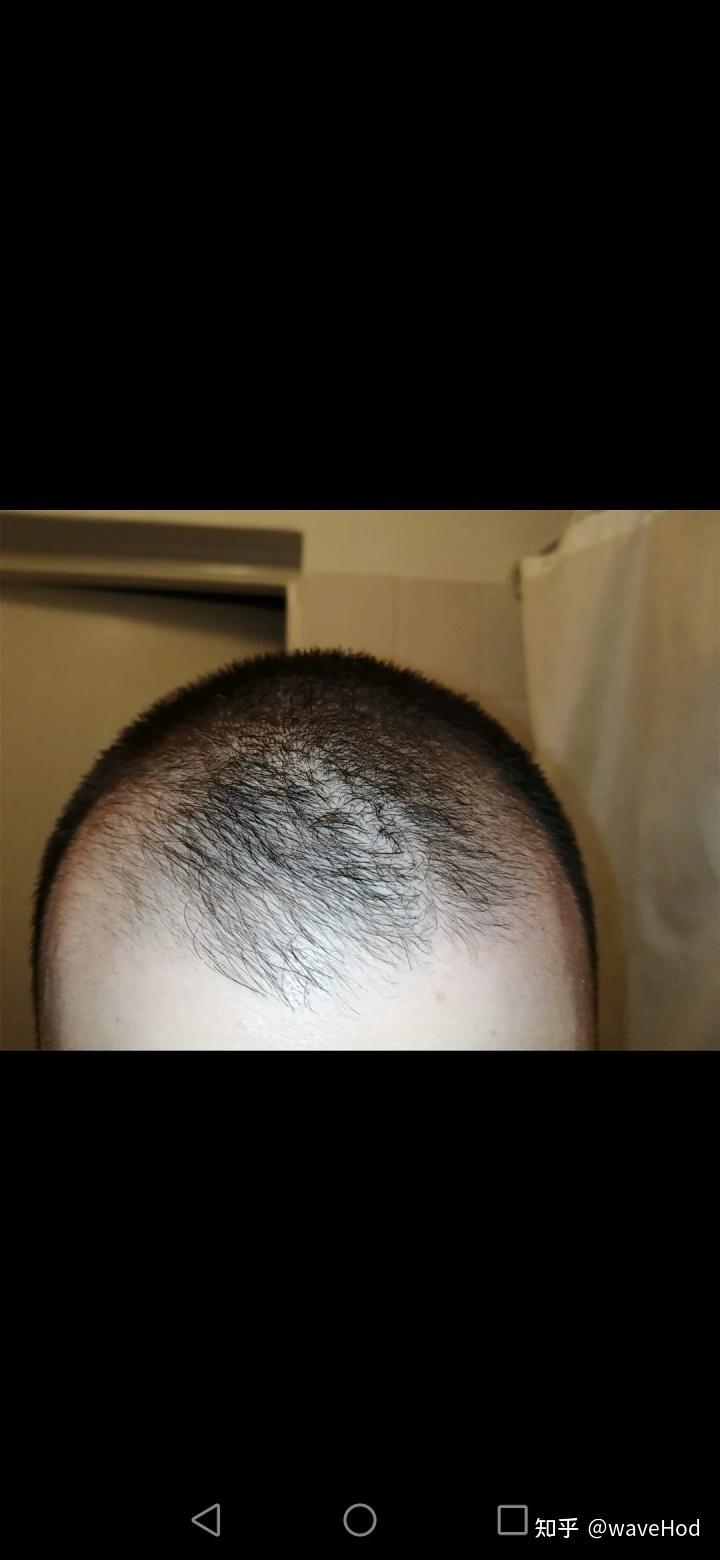 米诺地尔微针滚轮4个月的效果微针选择的详细说明