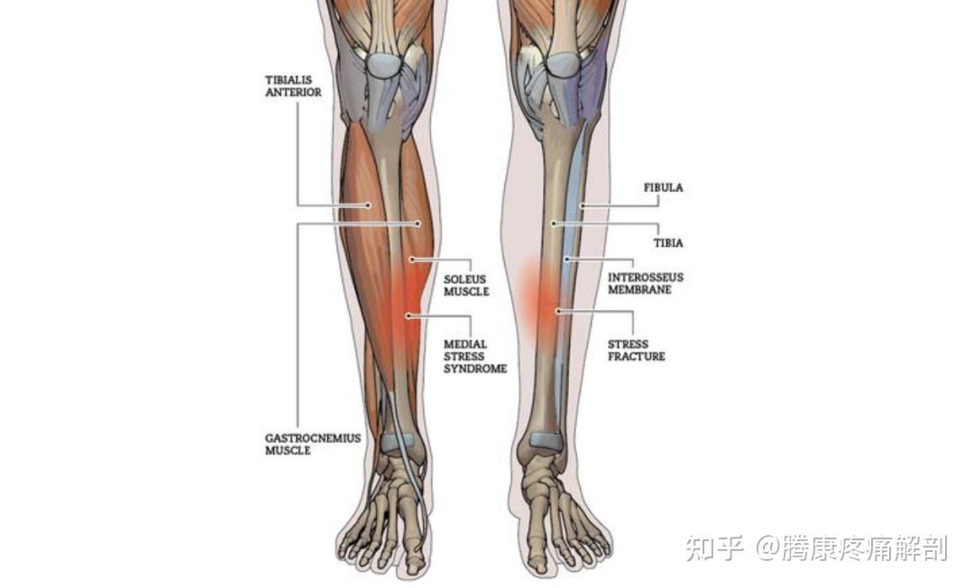 小腿疼痛——脛骨內側應力綜合徵分析與診療 - 知乎