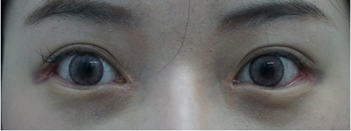 案例2: 内眦开大,下至,外眦开大术后