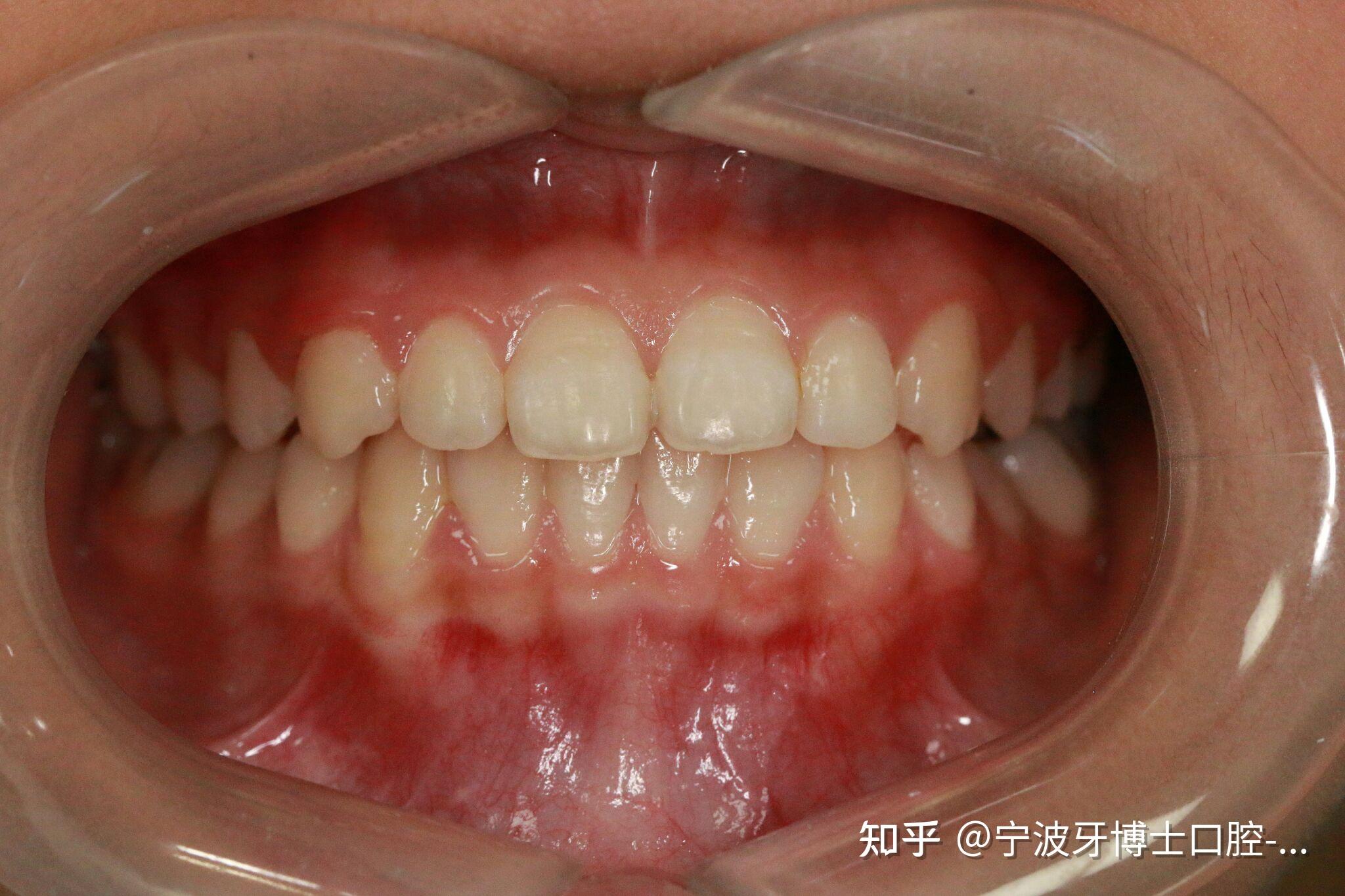 科普孩子地包天早发现早治疗