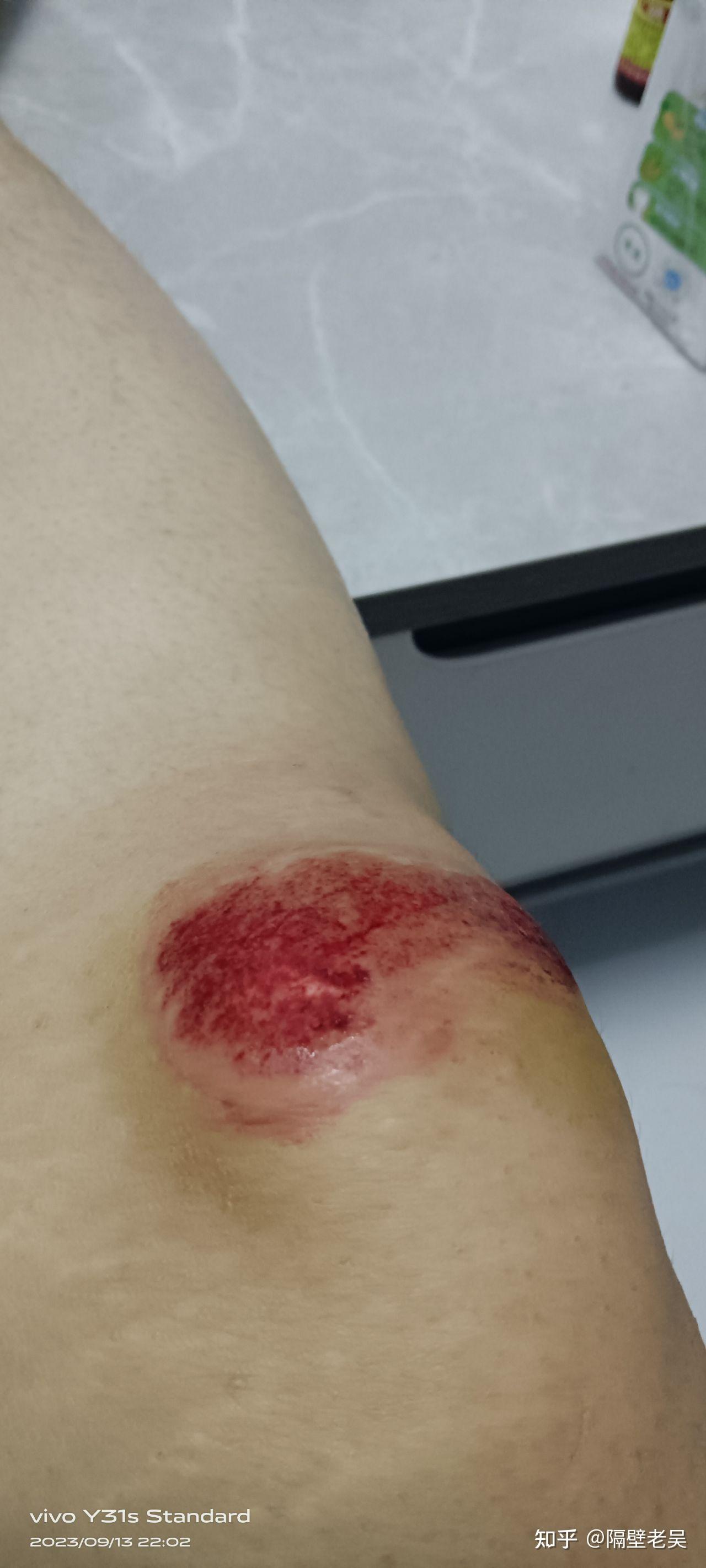 记录膝盖擦伤恢复过程