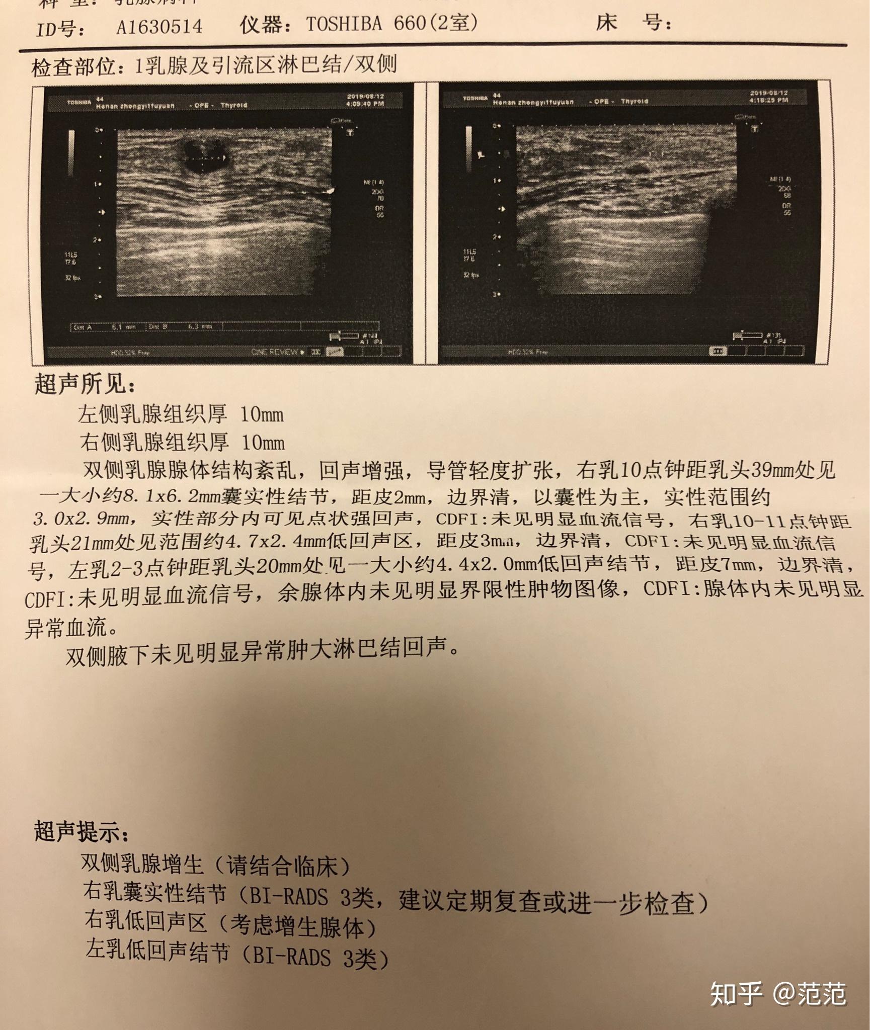 正常乳腺超声图像图片