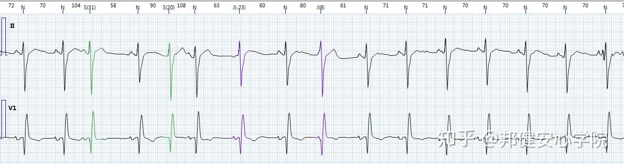 p波双向的心电图图片