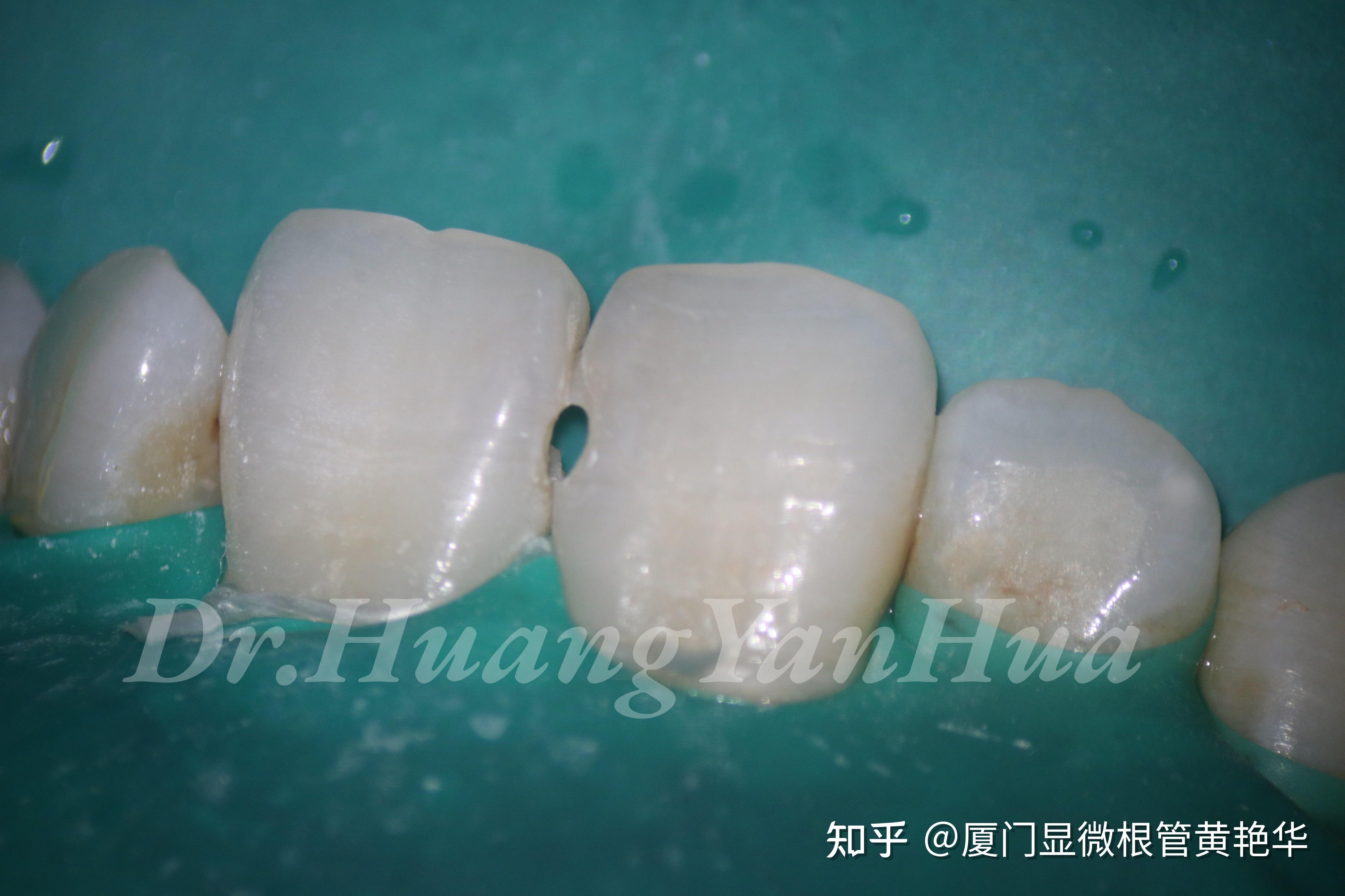 醫師，我的牙齒破掉了怎麼辦？------全瓷嵌體修復大範圍蛀牙 - 案例介紹 - 美容牙科張凱榮醫師