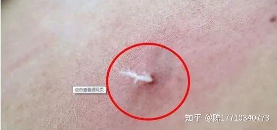羊毛疔是什么?“羊毛疔”长在人体穴位上,就会出现哪些病症 - 知乎