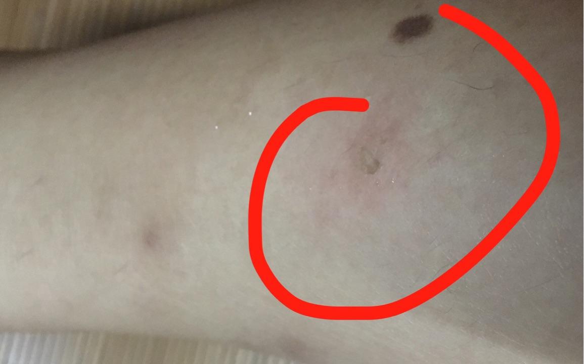 被狗咬过是种什么样的体验