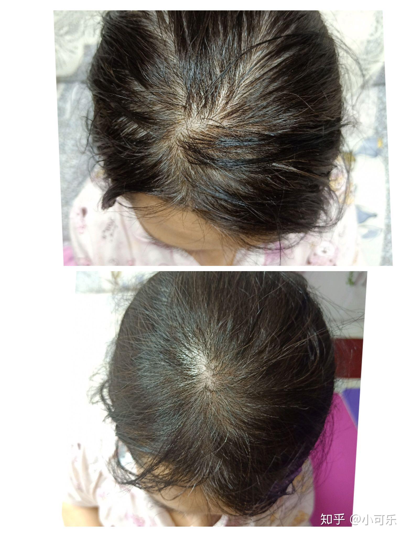 有没有好的生发产品 v2-ba13f5092bf217a84047e39ce70056a7_r.jpg