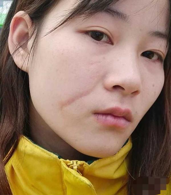 北京哪里祛除疤痕好,哪个医院治疗疤痕效果比较明显?