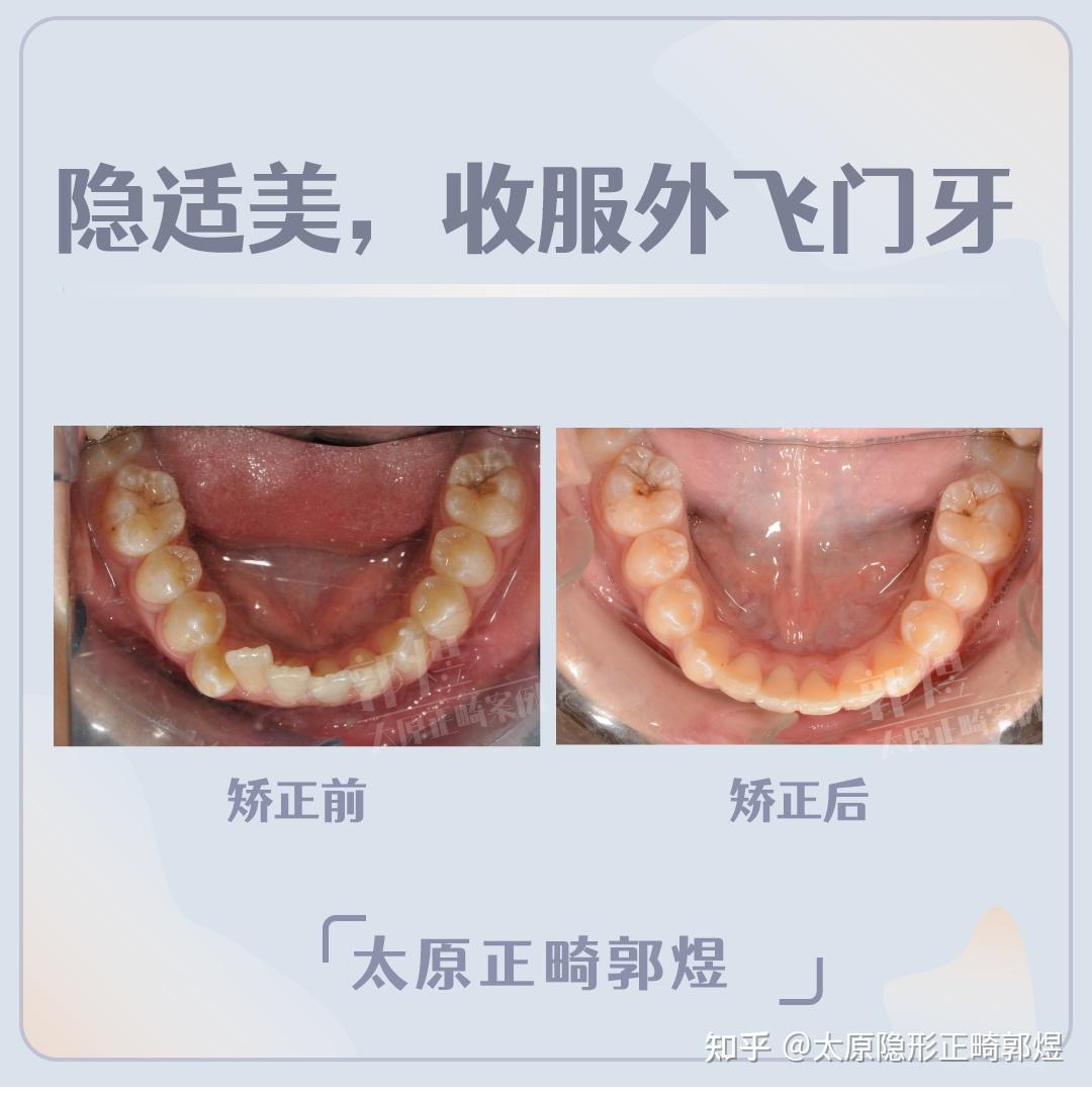 太原牙齿矫正丨牙齿不齐门牙外飞怎么办