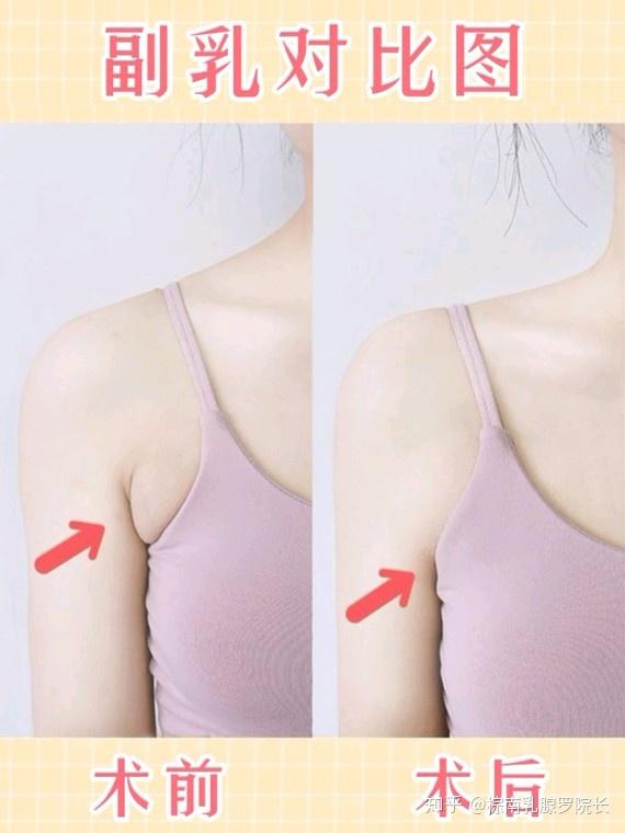 副乳去除步骤案列分享