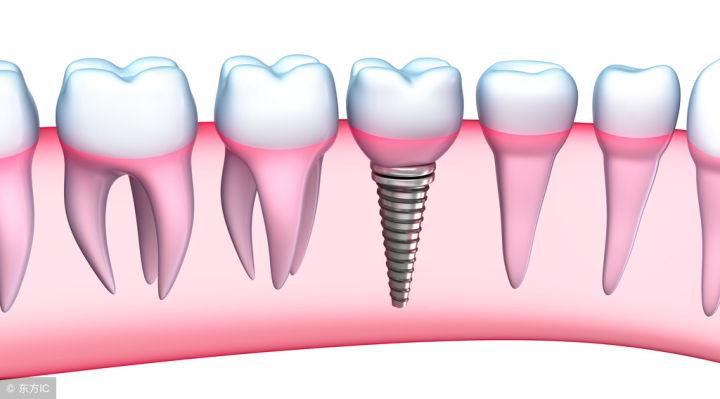 种植牙是不是只有老年人能做?
