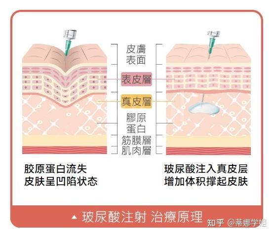 玻尿酸注射原理图片