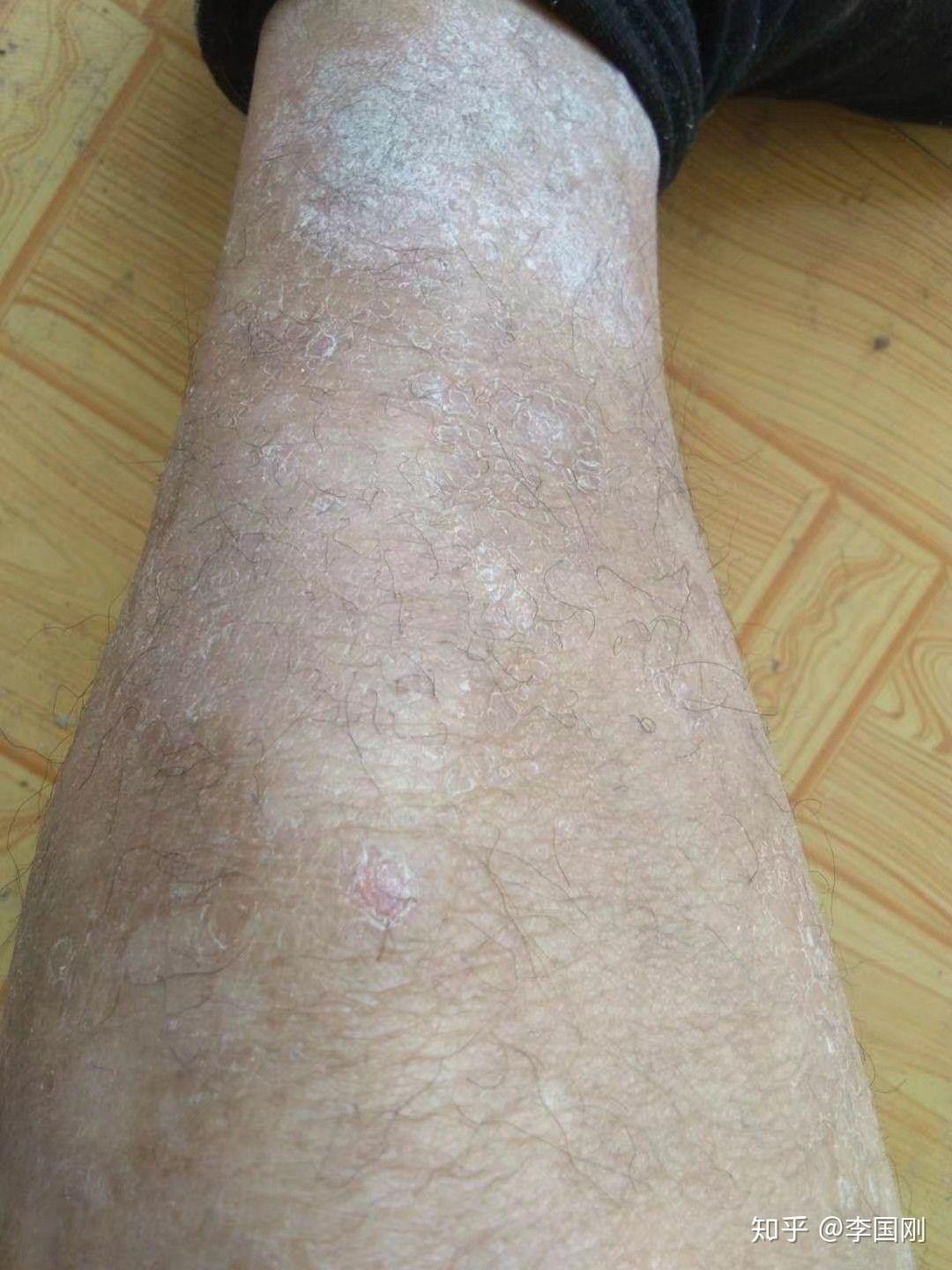 腿部直接消退顺序图片黑龙江齐齐哈尔
