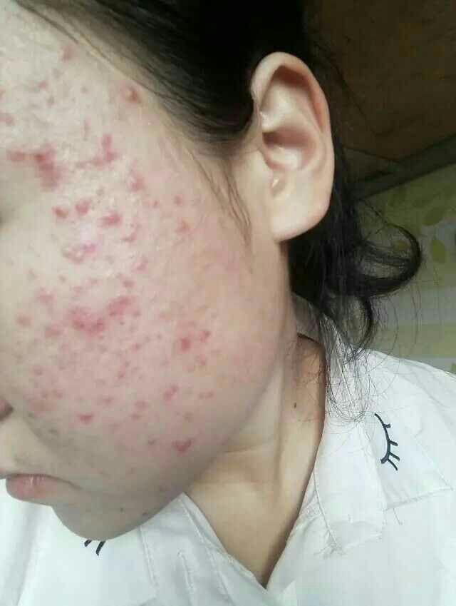 满脸痘痘很自卑,怎么办? - 知乎