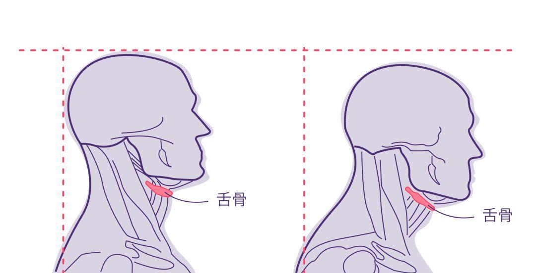 如果你有圆肩驼背头前伸,那么张力过大的胸部肌群会拉扯舌部肌群导致
