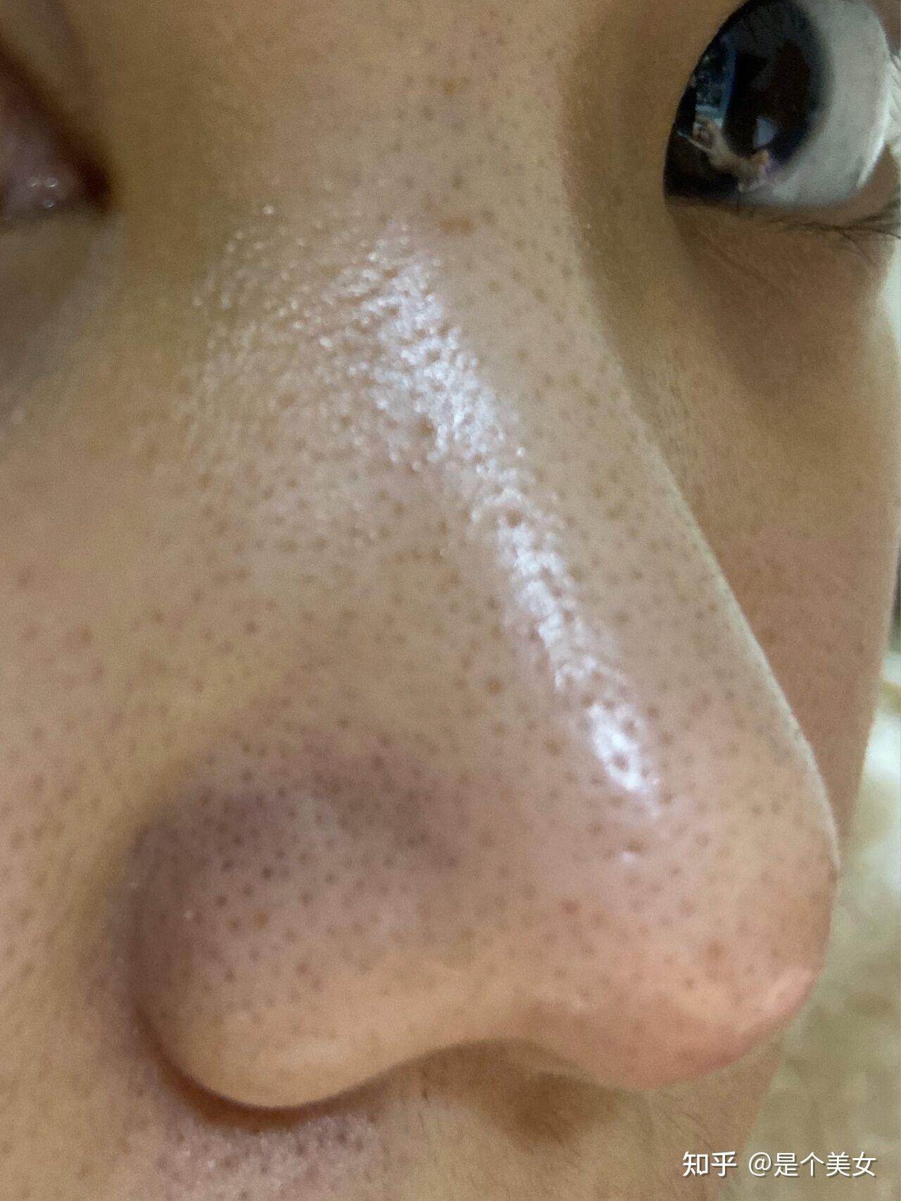 鼻子两边都是黑头快把毛孔顶开了怎么快速祛黑头啊捉急
