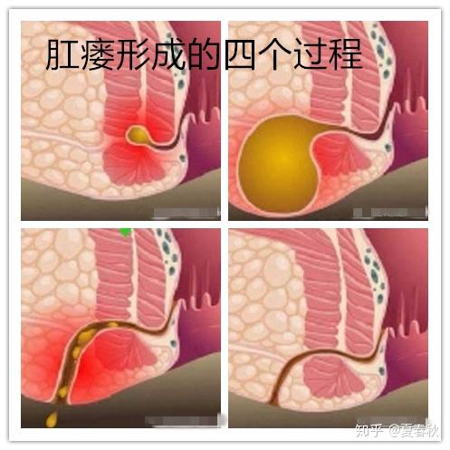 不知道什么时候开始,我发现肛门附近肿起来一块,而这个肿块自打有之后