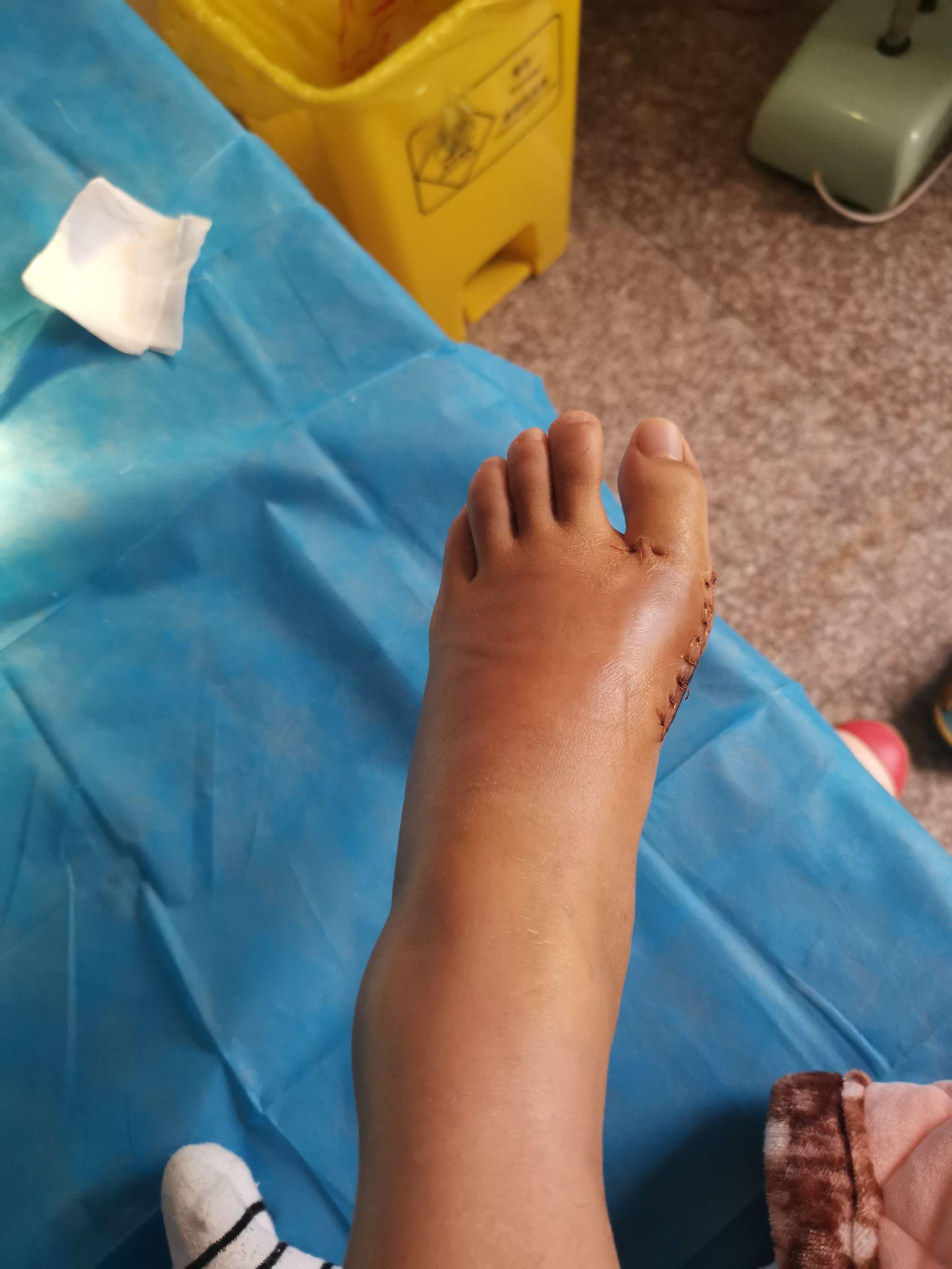 我的拇外翻手术过程术后两周