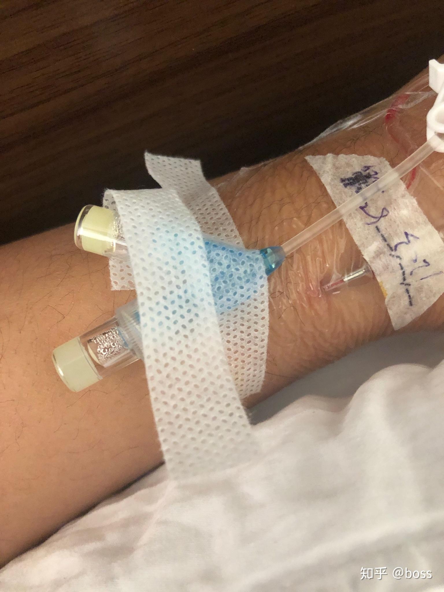 第一天挺舒服的,不难受,这边建议住院手术,住院做手术会给你打止痛针