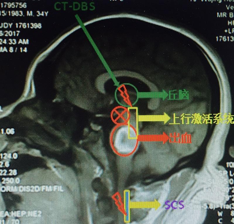 起搏大腦促醒腦幹出血昏迷病例分析