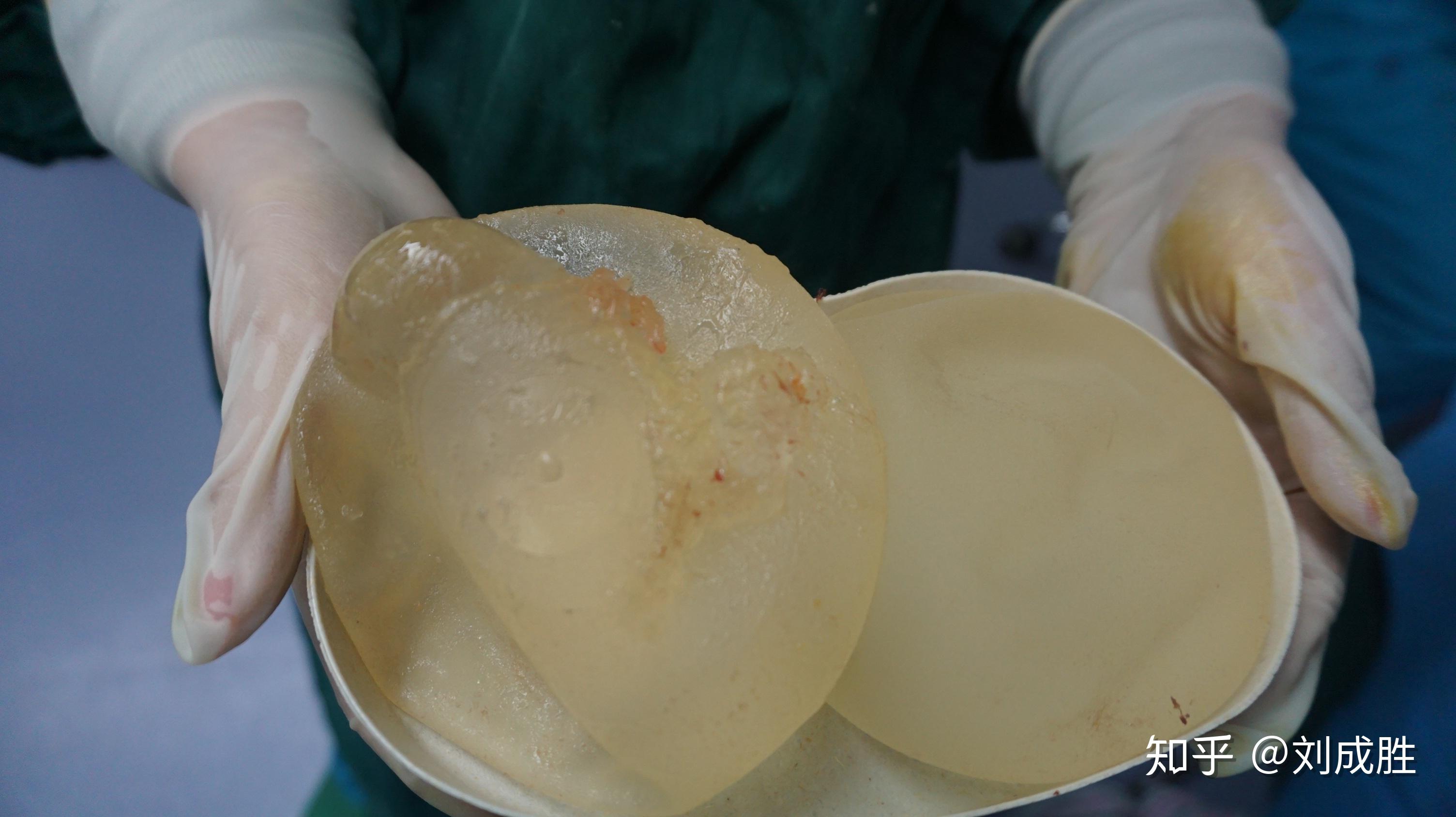 四,假体取出后怎么办?