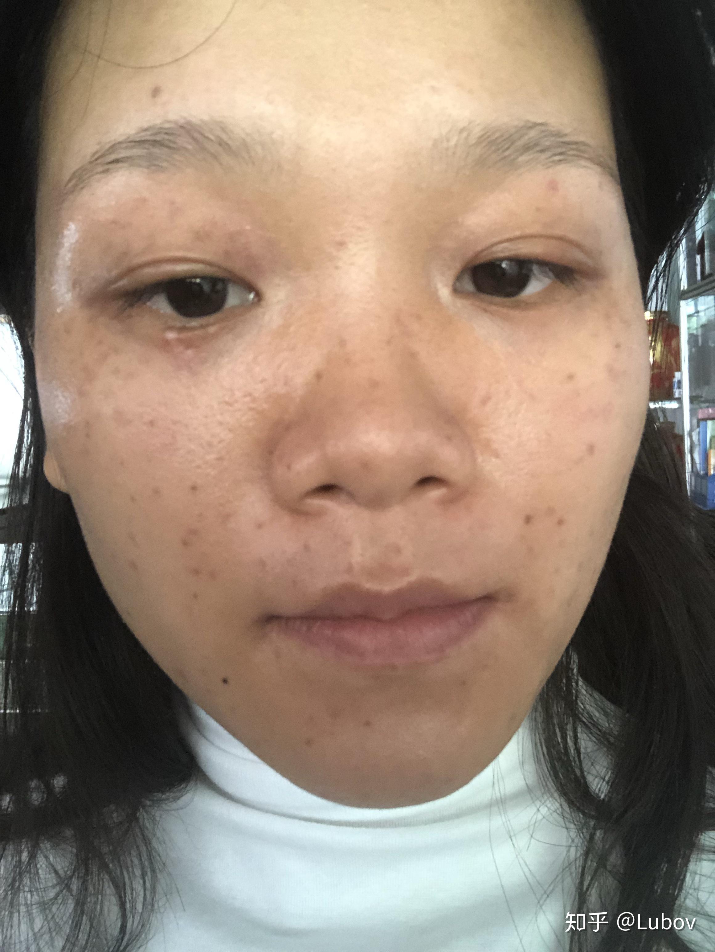 祛斑提取后美容院说要用他家产品一年感觉要吃土了